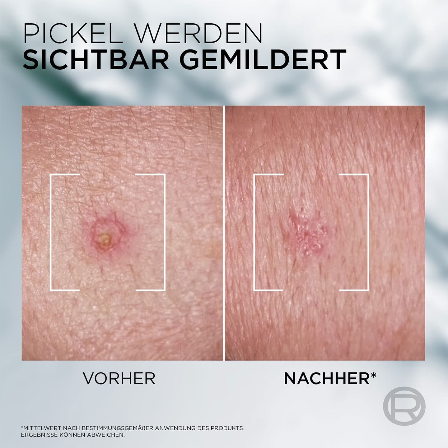 Vorher-Nachher-Schaubild: links unreine Haut, rechts glättere, reinere Haut